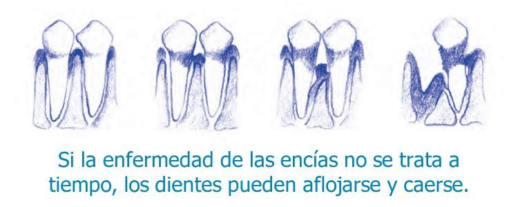 periodontitis o enfermedad de las encías
