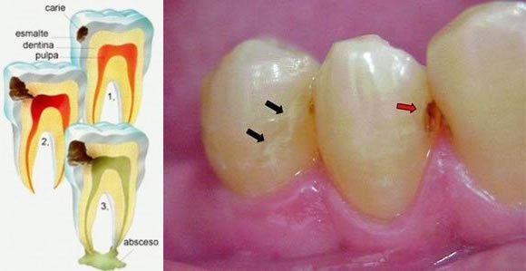 causas de las caries esmalte dentina pulpa absceso