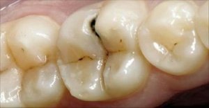 Caries y brackets