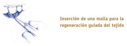 inserción de una malla para regeneración guiada del tejido