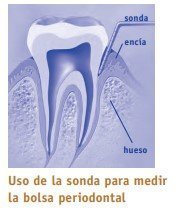 peridonntitis, uso de la sonda para medir la bolsa periodontal