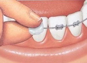 Cera para brackets