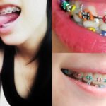 brackets de moda