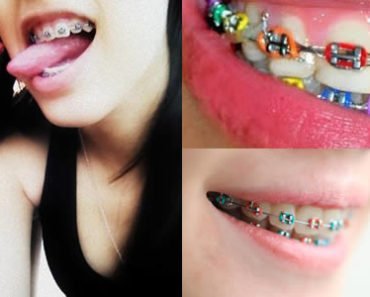 brackets de moda