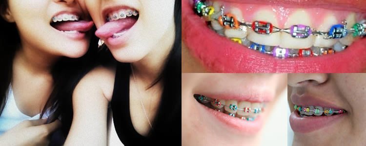 brackets de moda