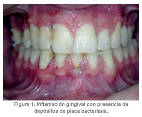 Figura 1. Inflamación gingival con presencia de