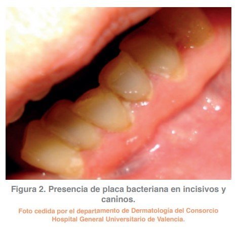 Figura 2. Presencia de placa bacteriana en incisivos y