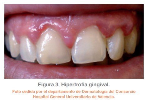 Figura 3. Hipertrofia gingival.