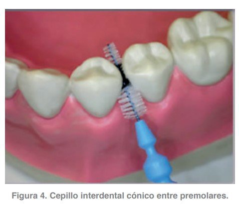 Figura 4. Cepillo interdental cónico entre premolares.