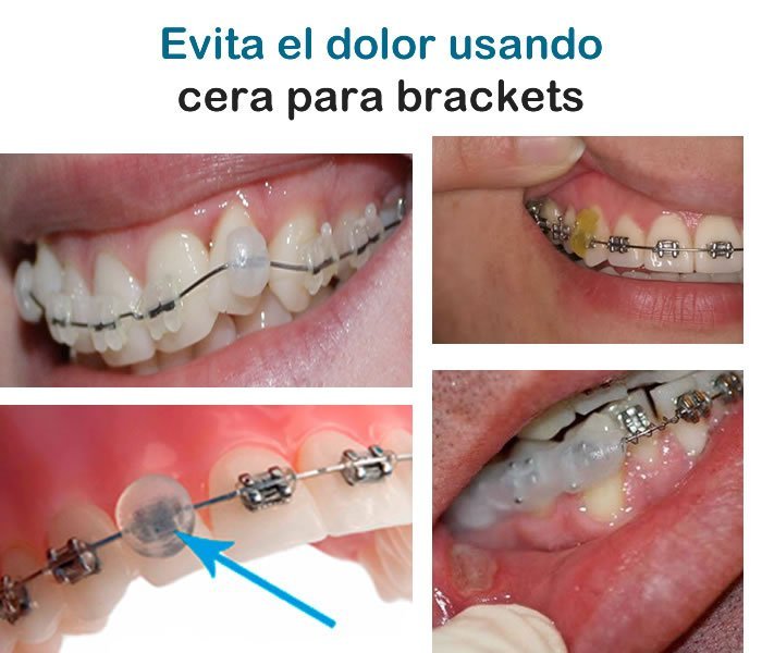 cera para brackets precio casera como hacer donde venden