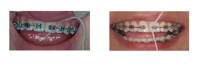 Con cuidado, retira el hilo dental