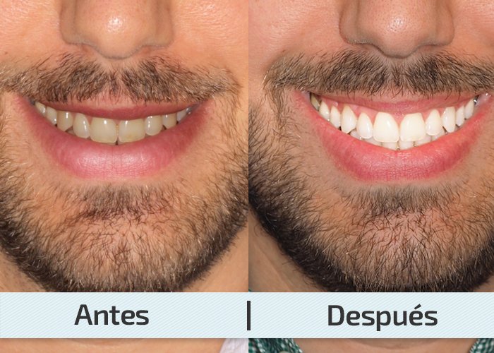 antes y despues blanqueamiento dental