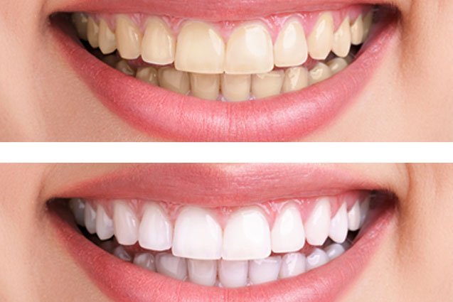 blanqueamiento dental en lima peru