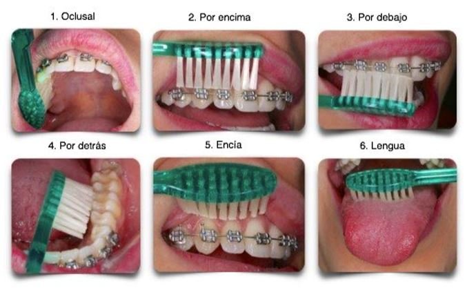cepillado-de ortodoncia peru