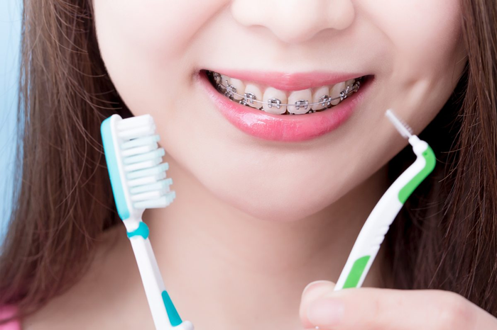 cepillar los brackets