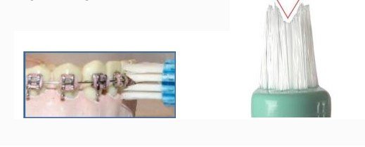 tecnicas de cepillado para los brackets