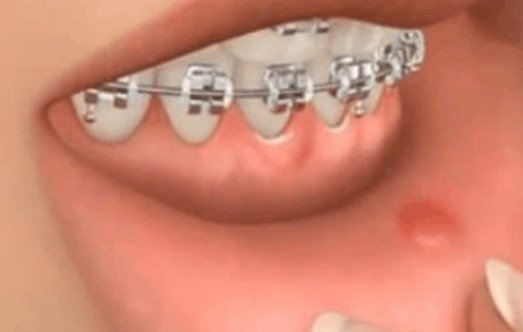herida por los brackets