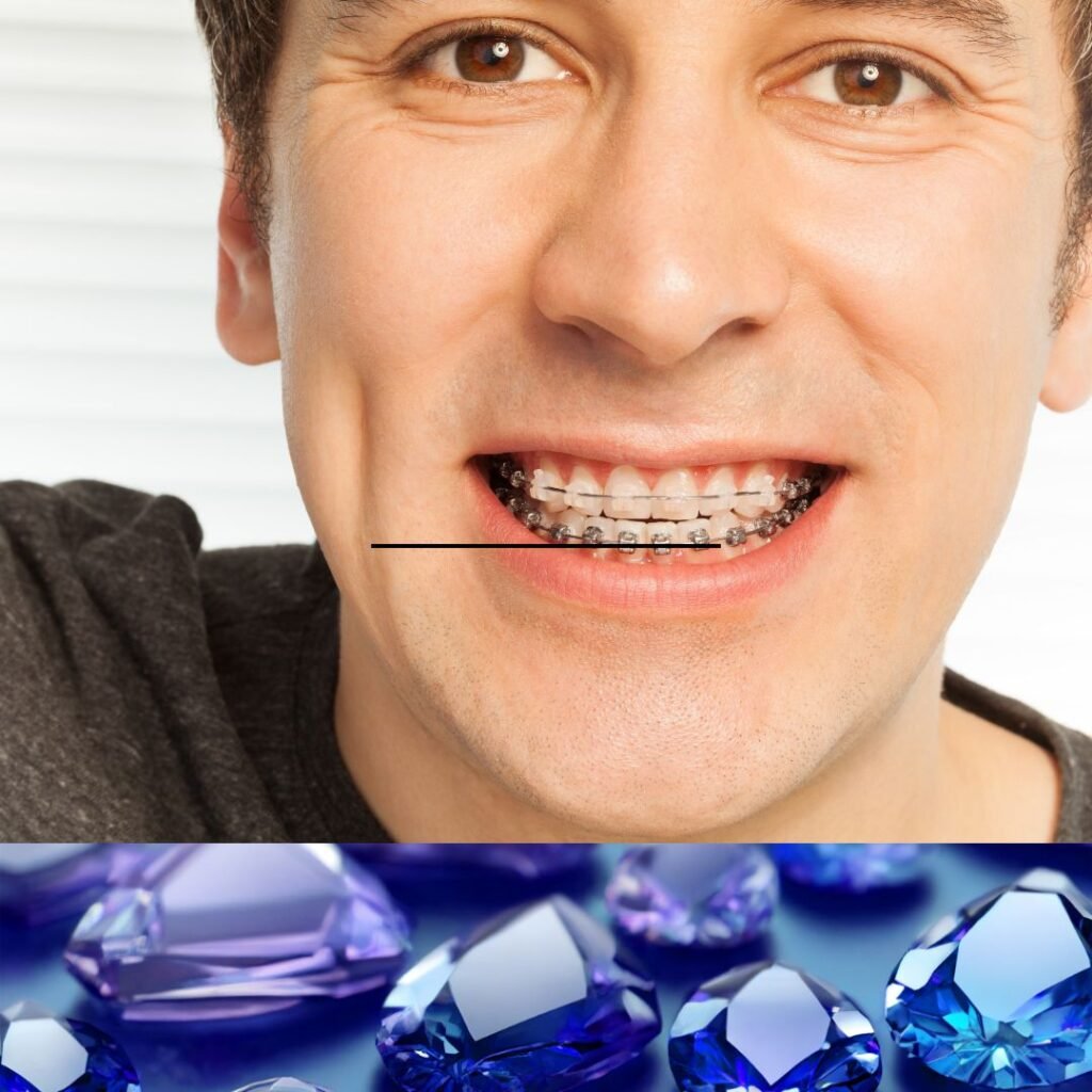 Brackets de Zafiro