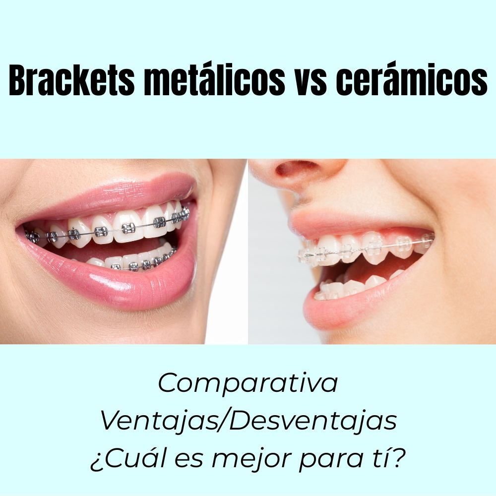 Brackets metálicos vs cerámicos